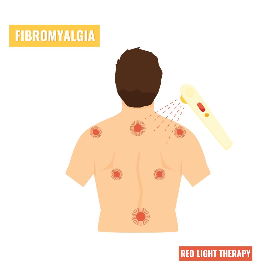 Red Light Therapy for Fibromyalgia